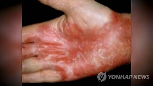 '폭염에도 반팔 못 입는' 건선 환자 84%, 모욕·차별 경험 - 2
