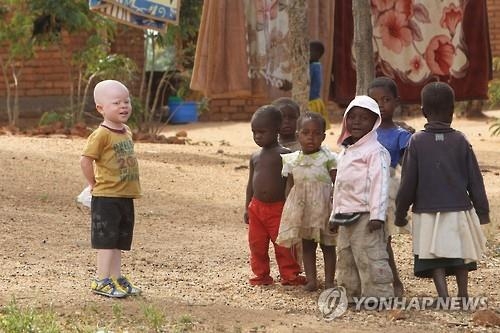 '하얀 흑인' 탄자니아 백색증 환자 "우리도 똑같은 사람" - 2