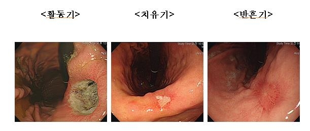 위궤양 단계별 모습