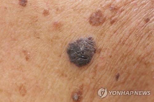 피부암