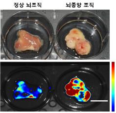 (서울=연합뉴스) 정상 뇌 조직(사진 왼쪽)과 교모세포종의 조직(사진 오른쪽)에 새로 개발한 탐침자를 분사하였을 경우 1분 이내에 뇌종양 조직에서만 붉은색으로 변하는 것이 확인됐다. 2020.06.02. [서울대병원 제공]