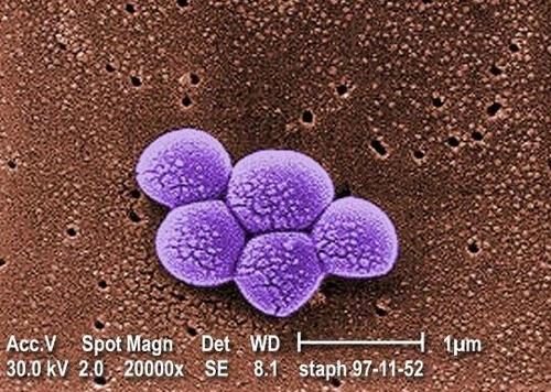 MRSA 슈퍼버그
