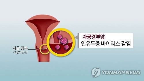 자궁경부암(CG)