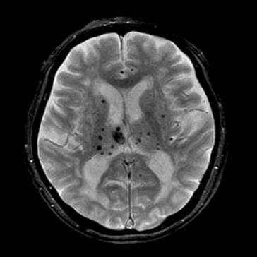 미세 뇌출혈 MRI 사진