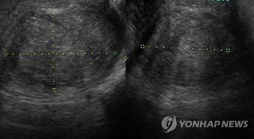 자궁근종 초음파 사진