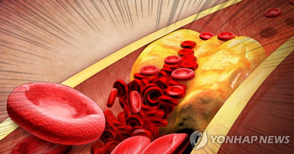 콜레스테롤 쌓인 혈관 (PG)