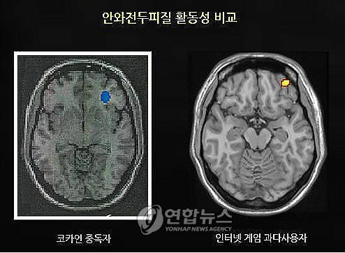 마약중독자와 같은 게임중독자의 뇌