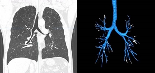 "1㎜ 미만 미세기관지, 인공지능으로 잡아낸다"