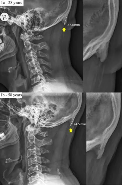 28세 청년의 두개골 엑스레이(위)와 58세 중년의 엑스레이(아래)