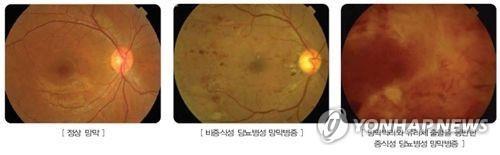 당뇨병성 망막병증