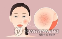 미국 FDA, 안면홍조 비호르몬 치료제 최초 승인