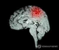 사람잡는 불면증…50살 아래서 뇌졸중 위험 껑충