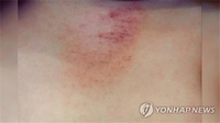 "아토피 피부염, 염증성 장 질환과 연관있다"