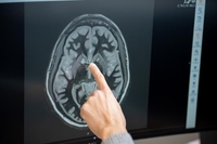 %22당뇨·비만약 티르제파티드, 음식 갈망 단기간 억제 효과%22