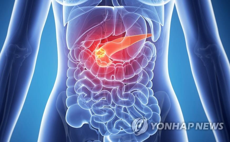 췌장암 이미지