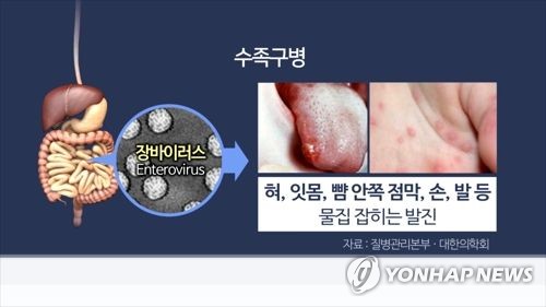 치료제 없는 수족구병 백신 나올까…CJ헬스, 임상 개발 속도