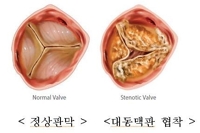 "대동맥 협착, 수술보다 스텐트 시술이 유리"