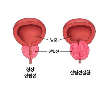 전립선 비대증